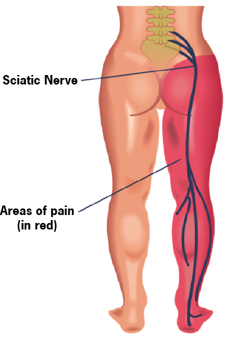 Sciatica Treatment-Causes & Cure, Mission Viejo at Winchell Chiropractic