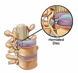 Herniated Disc Treatment In Orange County, CA at Winchell Chiropractic