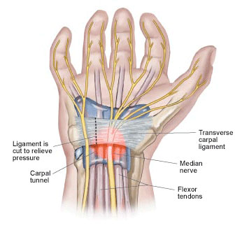 Carpal Tunnel Syndrome: Symptoms & Treatment | Winchell Chiropractic