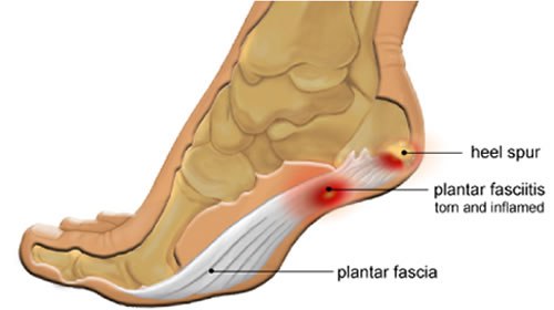 laser treatment for bone spurs in foot