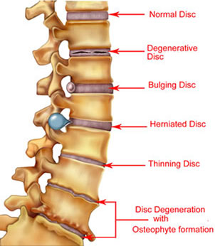 Bulging Disc Treatment In Orange County, CA at Winchell Chiropractic