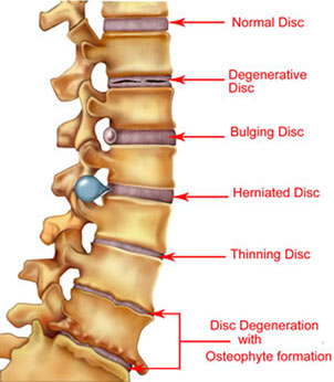 Herniated Disc Treatment