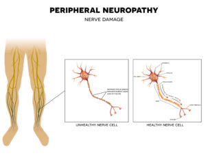 Neuropathic Pain: Causes & Best Treatment, CA at Winchell Chiropractic